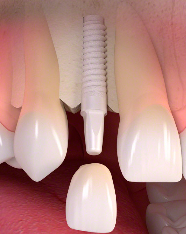 Parodontologia.it - impianto-zirconia